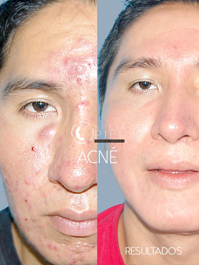 acne 2 foto antes y despues