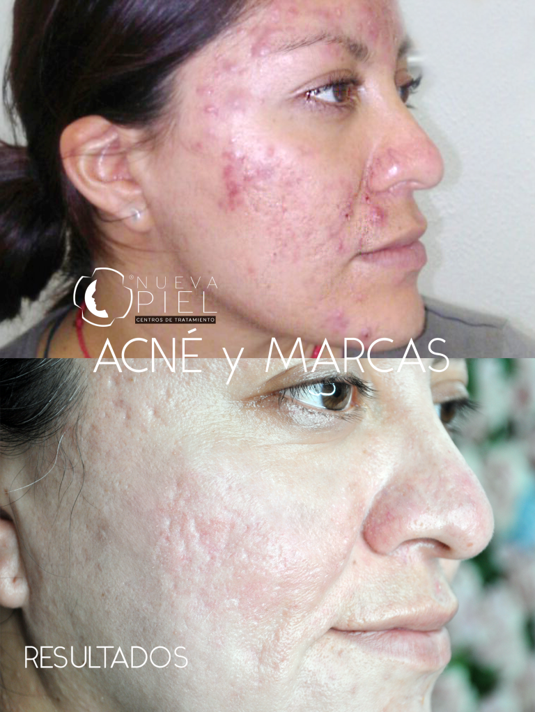 acne adi gaeriaa_