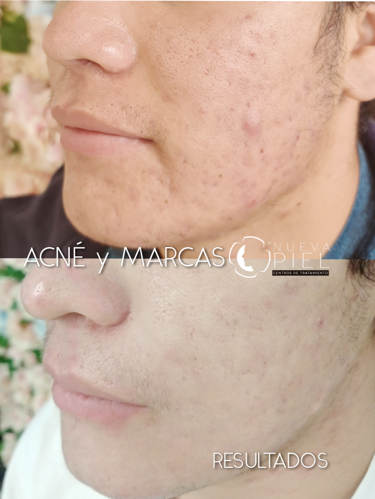 acne y masrcas 32