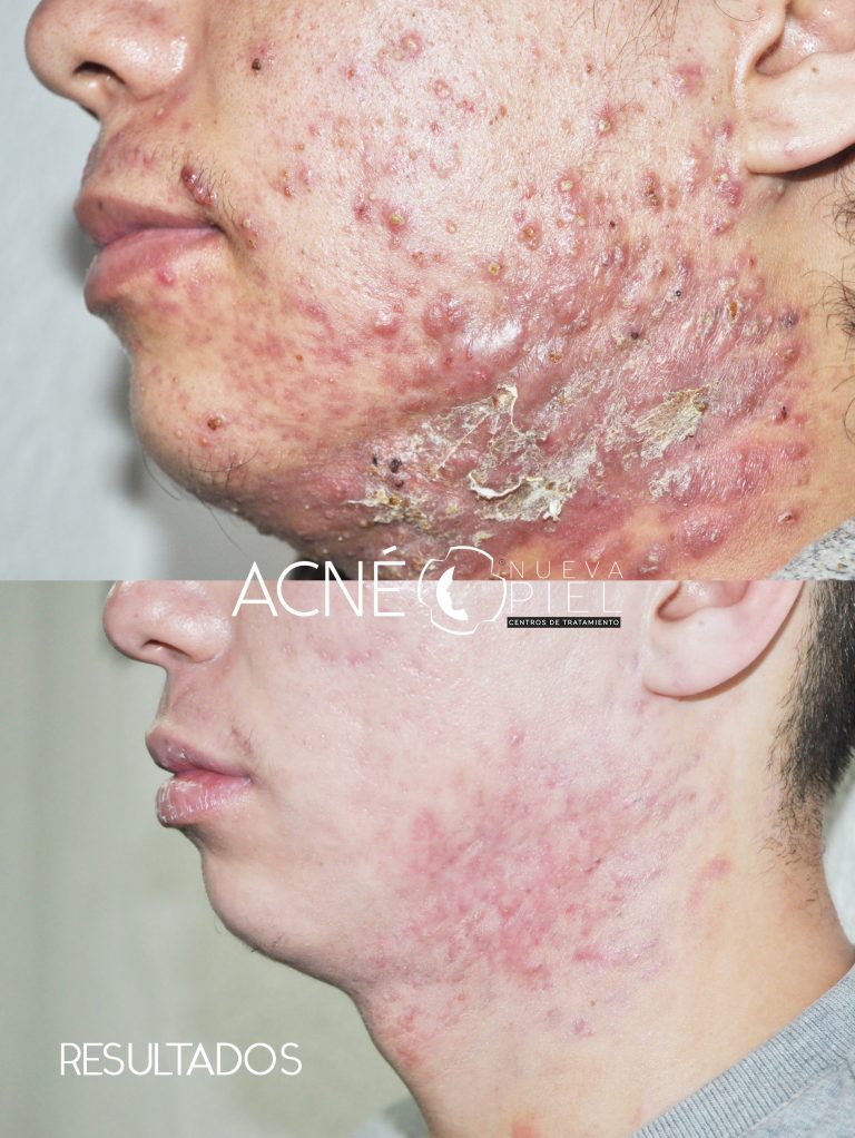 antes y despues acne pagina_