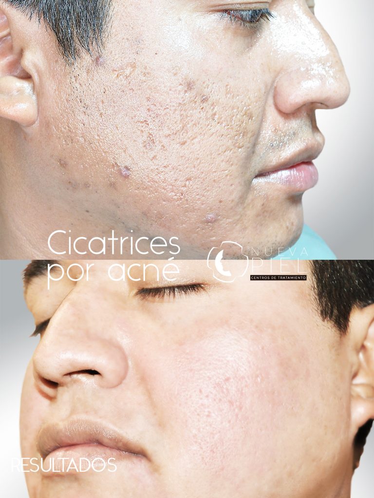 cicatrices por acne carrucel